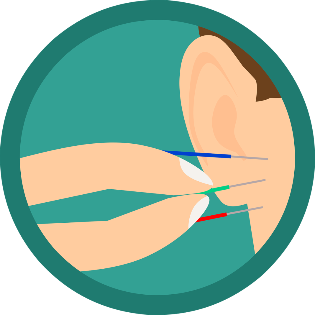 acupuncture, ear, needles-3654316.jpg